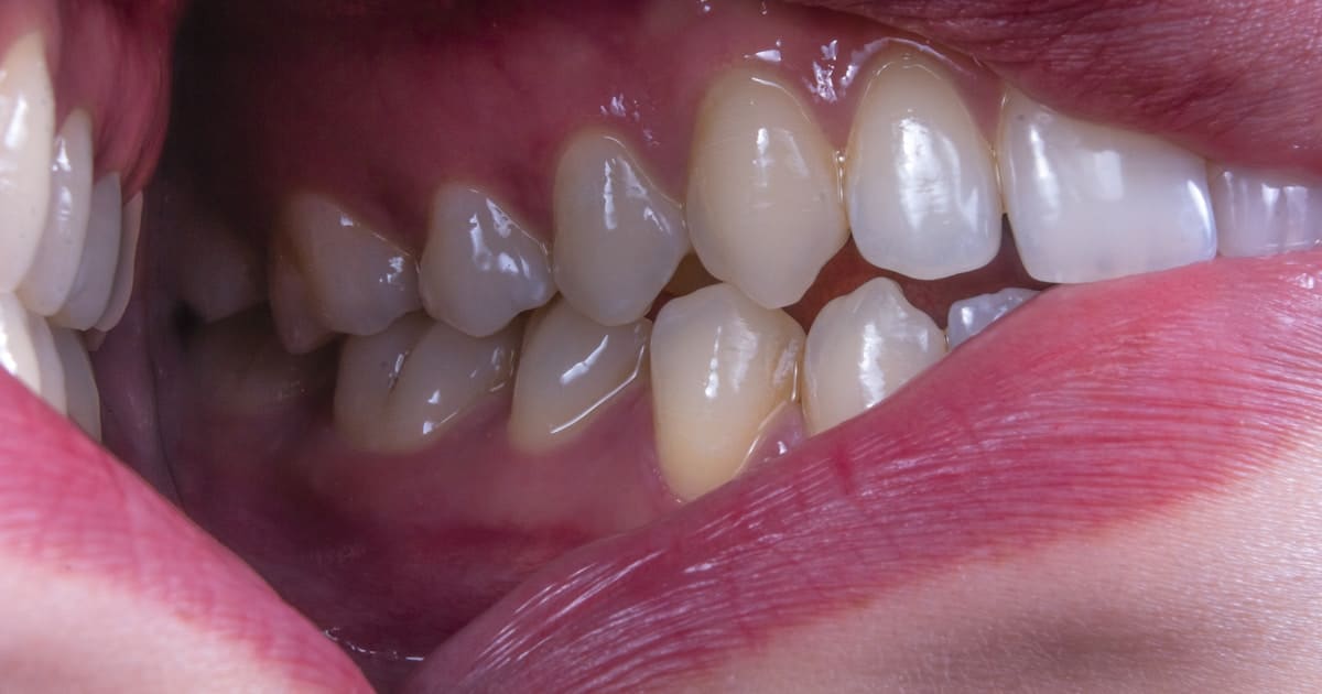 yapay zeka ses hastalık belirtileri